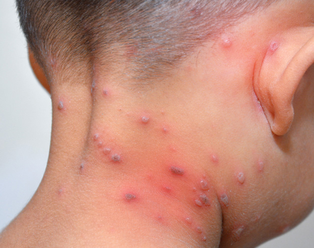 Chickenpox - Miles Pharmacy