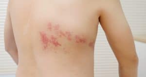 Shingles Vacciantion