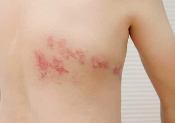 Shingles Vacciantion