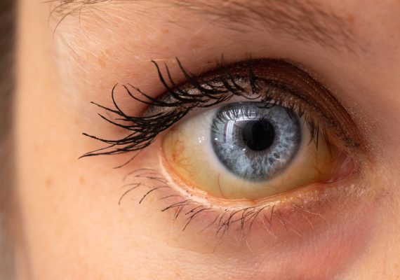 Symptoms Of Yellow Fever And How To Prevent It