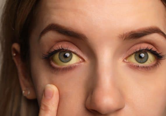 Yellow Fever Vaccination in Ashtead and Epsom area - Miles